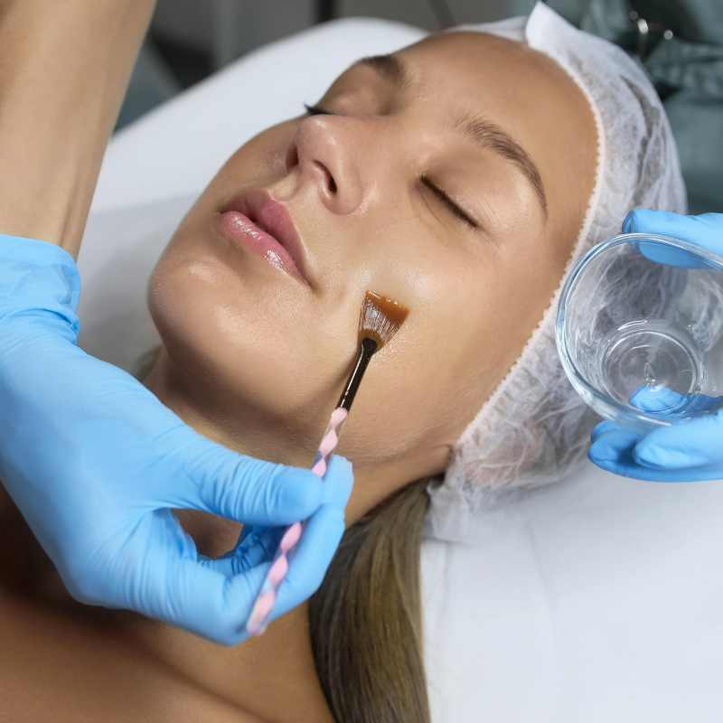 Chemical Peels — Reveal, Renew, Refresh