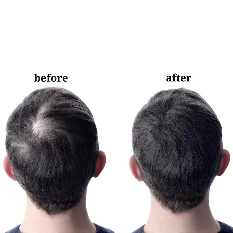 Exosome Hair Restoration — A Natural Path to Thicker Hair