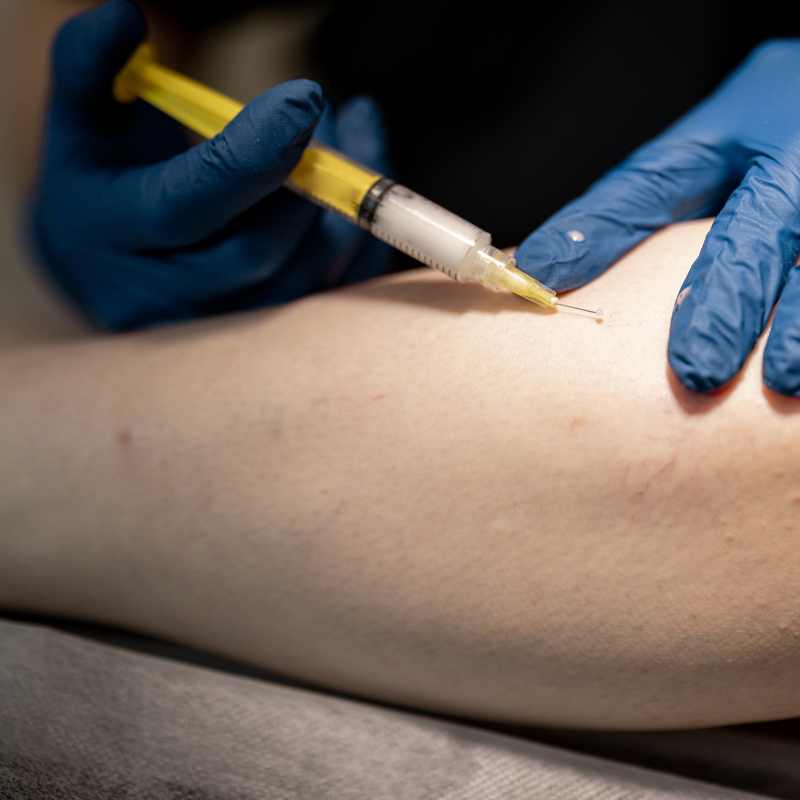 Sclerotherapy — Goodbye, Spider Veins